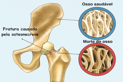 O que é Osteonecrose e como identificar