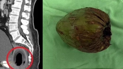 Cirurgiões removem coco verde de 9 cm do ânus de homem