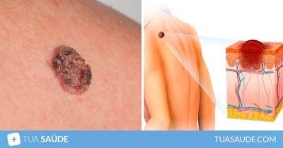 Câncer de pele: veja como identificar os sinais e como tratar