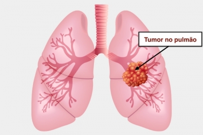 Câncer de pulmão: principais causas (e não é só o cigarro)