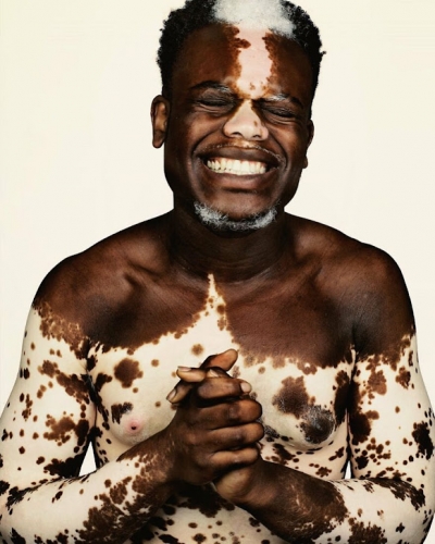 Fotógrafo mostra pessoas com peles únicas