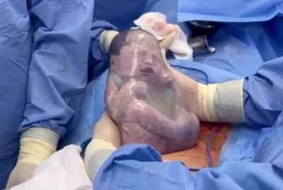Vídeo raro mostra bebê empelicada, você sabe o que é isso?