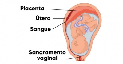 Descolamento de placenta: o que Ã©, sintomas e como tratar