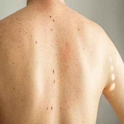 Dezembro Laranja: Dermatologista ensina quais são os sinais de alerta e sintomas