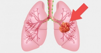 Nódulo no pulmão: o que significa e quando pode ser câncer
