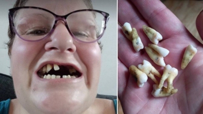 Sem dinheiro para ir a dentista, britÃ¢nica arranca sozinha 11 dentes