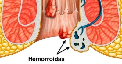 RemÃ©dios caseiros para Hemorroidas externas e internas